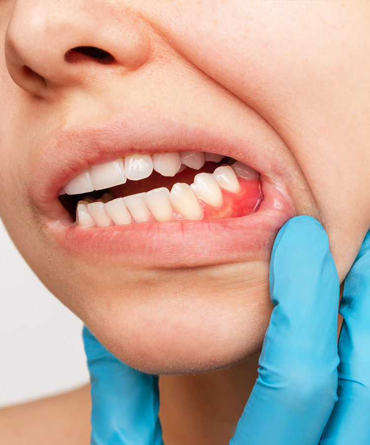 Laser Gum Disease Treatment
