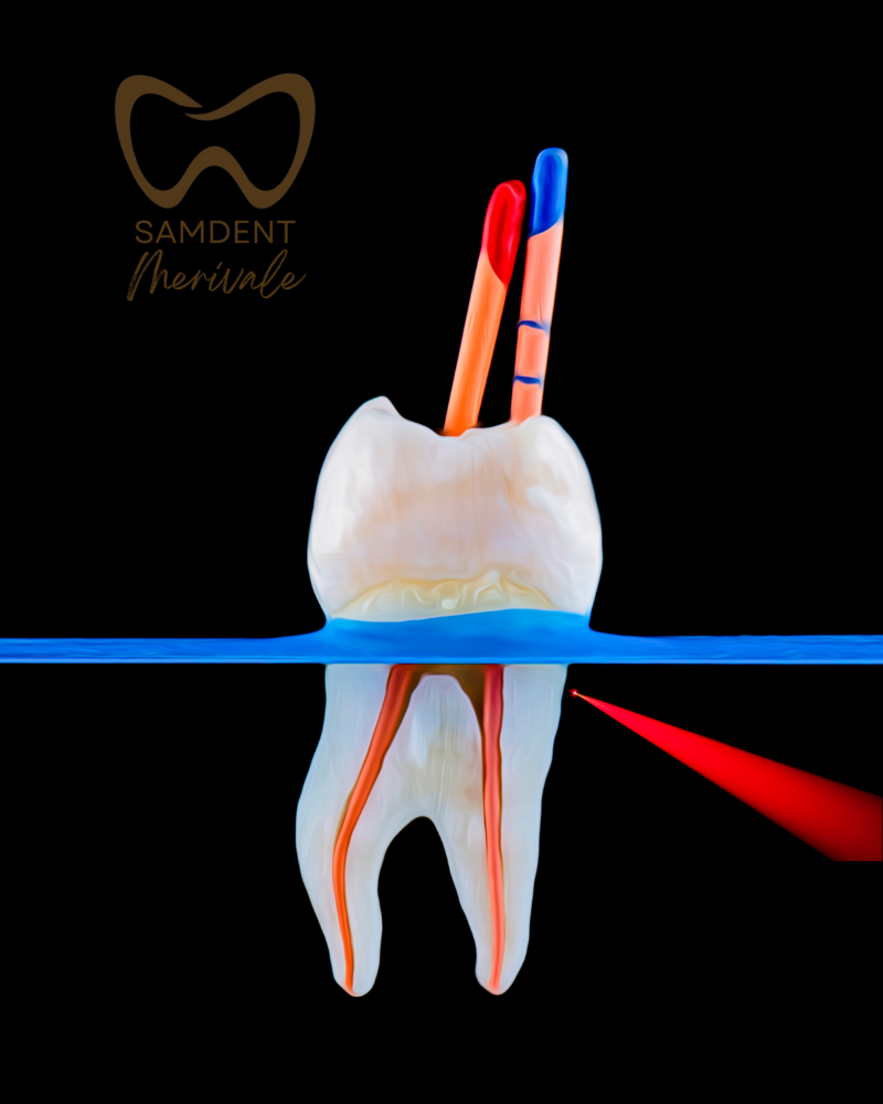 Advanced, Laser, Root Canal Therapy